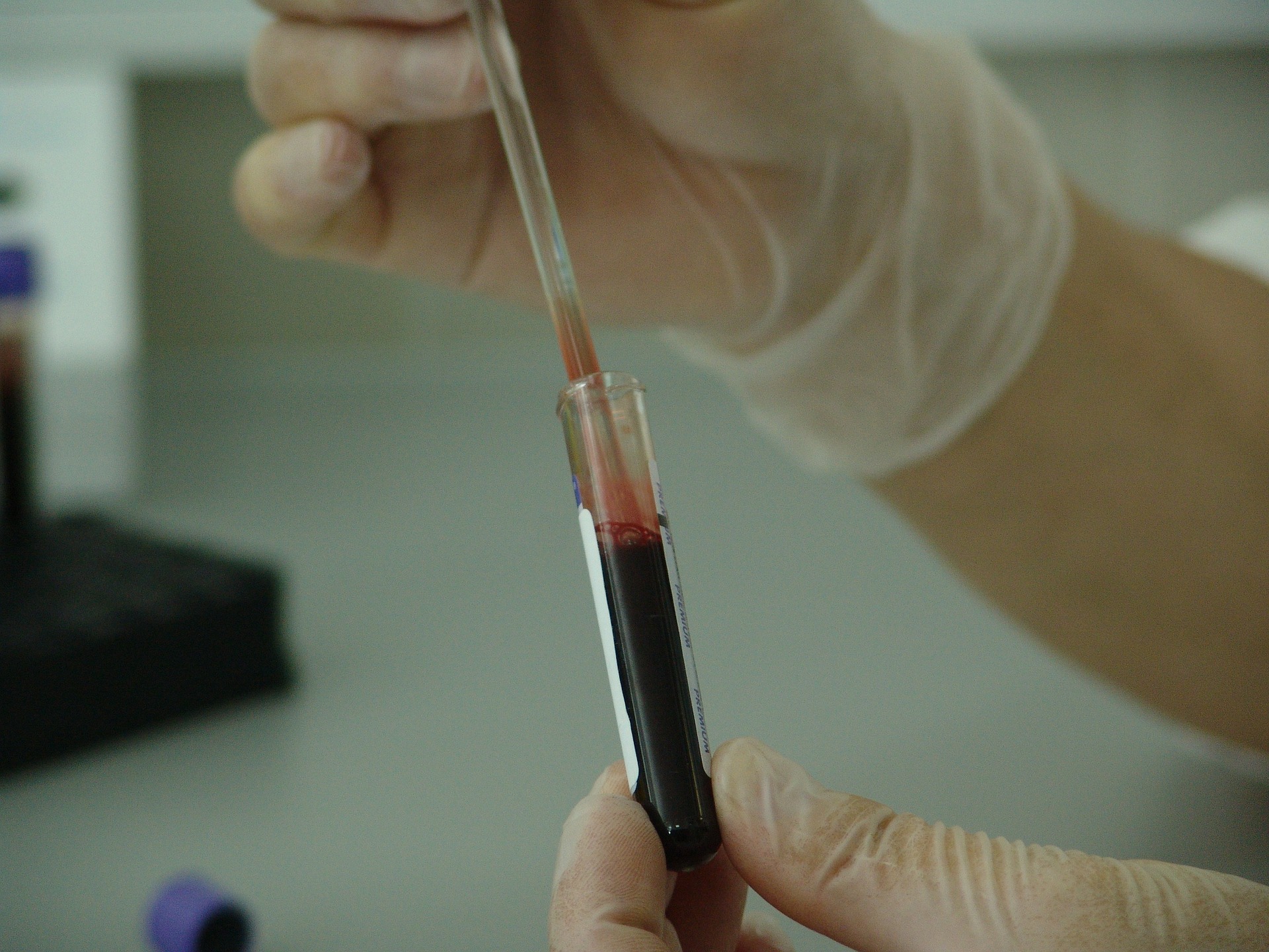 screening colite ulcerosa - analisi sangue