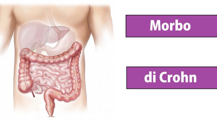 Morbo di Crohn - Malattia di Crohn - tipi di malattia di Crohn
